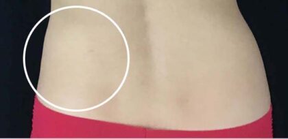 CoolSculpting Before & After Patient #11191