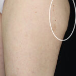 CoolSculpting Before & After Patient #11210