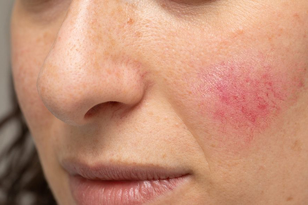 Rosacea