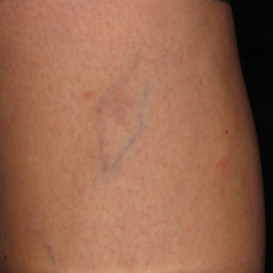Sclerotherapy Before & After Patient #11604