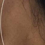 Cosmetic Mole Removal Before & After Patient #11265