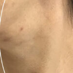 Cosmetic Mole Removal Before & After Patient #11265
