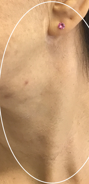 Mole Removal Before & After Patient #11265