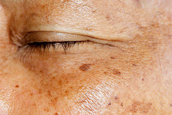 age-spots-causes-how-to-get-rid-cream-treatment