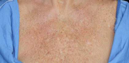 Skin Damage Before & After Patient #11085