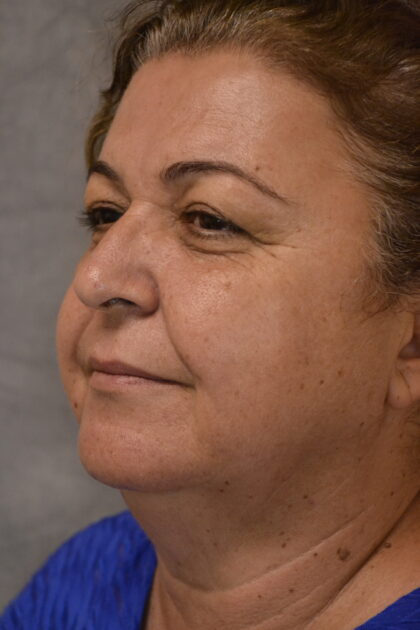 Facelift Before & After Patient #12055