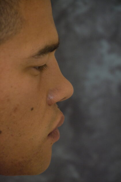 Rhinoplasty Before & After Patient #11955