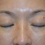 Blepharoplasty Before & After Patient #11943