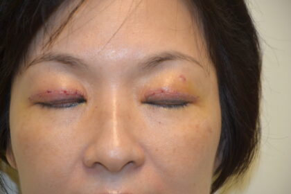 Blepharoplasty Before & After Patient #11943