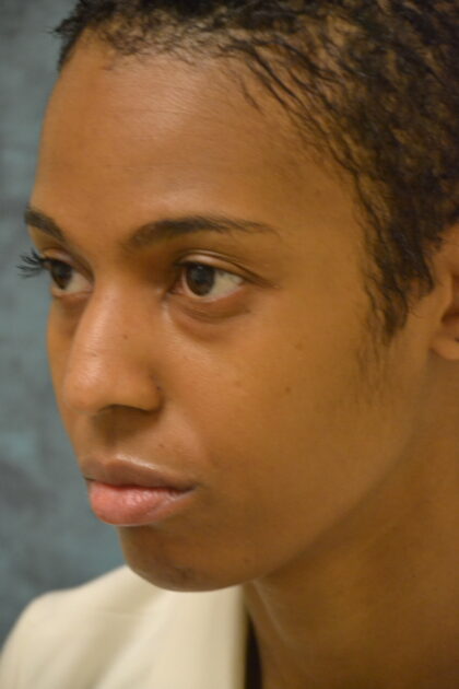 Rhinoplasty Before & After Patient #11950