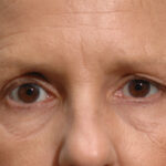 Blepharoplasty Before & After Patient #11938