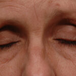 Blepharoplasty Before & After Patient #11938