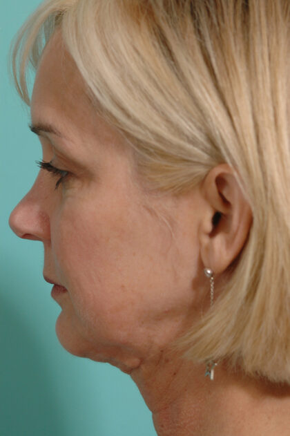 Necklift Before & After Patient #11986