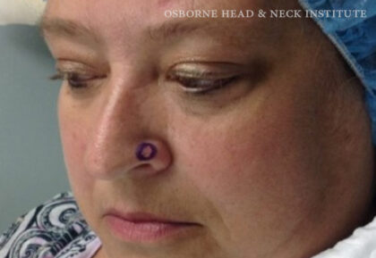Mohs Surgery Before & After Patient #12180