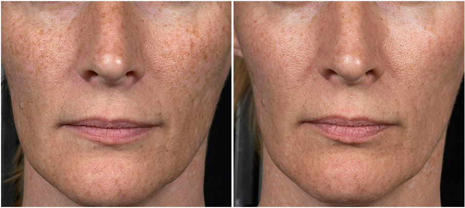 Chest Wrinkles from Sleeping and Sun Damage Removed with Fraxel