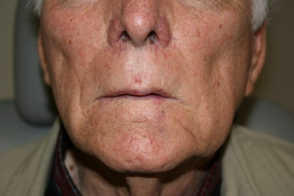 Mohs Surgery Before & After Patient #12190
