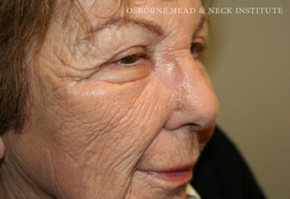 Mohs Surgery Before & After Patient #12187