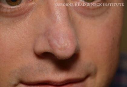 Mohs Surgery Before & After Patient #12184