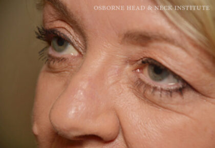 Mohs Surgery Before & After Patient #12193