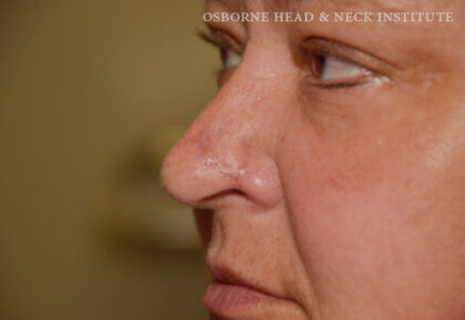 Mohs Surgery Before & After Patient #12180