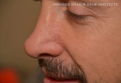 Mohs Surgery Before & After Patient #12177