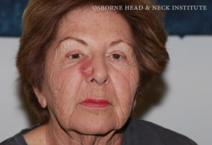 Mohs Surgery Before & After Patient #12187