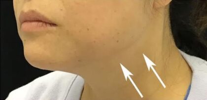 Jawline Contouring Before & After Patient #12575