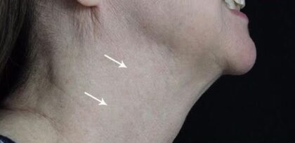 Jawline Contouring Before & After Patient #12581