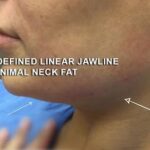 Jawline Contouring Before & After Patient #12584