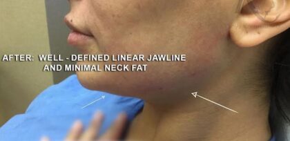 Jawline Contouring Before & After Patient #12584