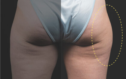 CoolSculpting Before & After Patient #12358