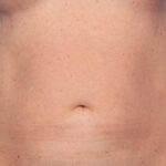 CoolSculpting Before & After Patient #12385