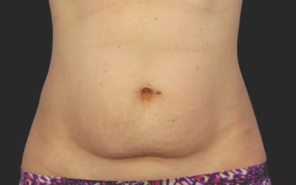 CoolSculpting Before & After Patient #12388
