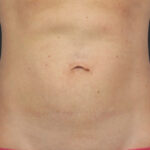 CoolSculpting Before & After Patient #12388