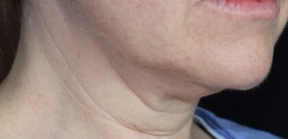 Jawline Contouring Before & After Patient #12398