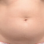 CoolSculpting Before & After Patient #12361
