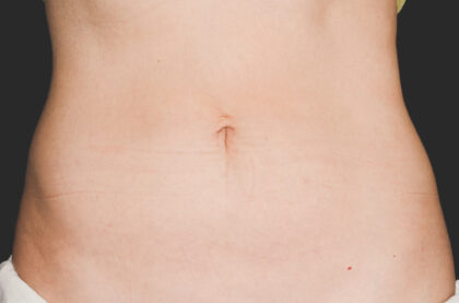 CoolSculpting Before & After Patient #12361