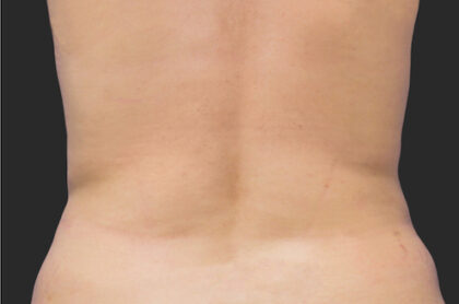 CoolSculpting Before & After Patient #12364