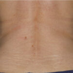 CoolSculpting Before & After Patient #12373
