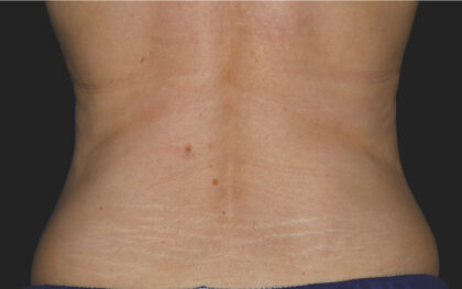 CoolSculpting Before & After Patient #12373