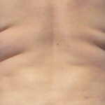 CoolSculpting Before & After Patient #12376