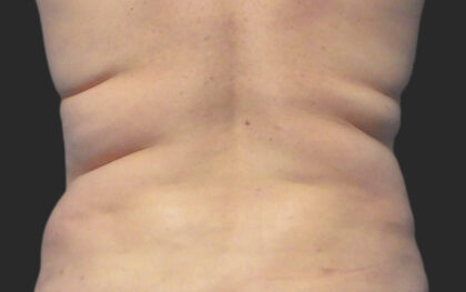 CoolSculpting Before & After Patient #12376