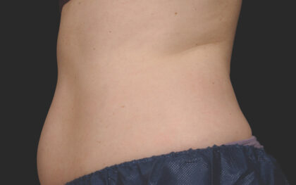 CoolSculpting Before & After Patient #12379