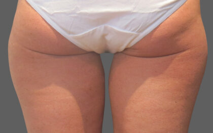 CoolSculpting Before & After Patient #12382