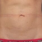 CoolSculpting Before & After Patient #12483