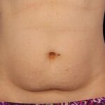 CoolSculpting Before & After Patient #12483