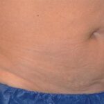 CoolSculpting Before & After Patient #12486