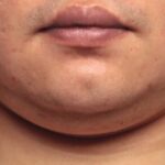 CoolSculpting Before & After Patient #12455