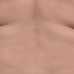CoolSculpting Before & After Patient #12458