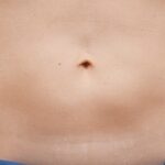 CoolSculpting Before & After Patient #12461